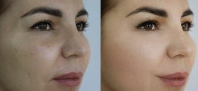 Tips How Do You Find The Best Botox In Tucson