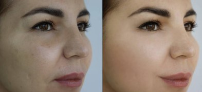 Tips How Do You Find The Best Botox In Tucson