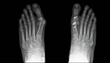 Why Trust Foot And Ankle Center Of Arizona For Osteotomy Foot Surgery