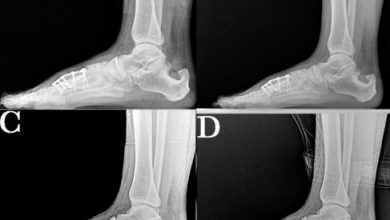 Who Is Best Performs Calcaneus Osteotomy Surgery In Scottsdale