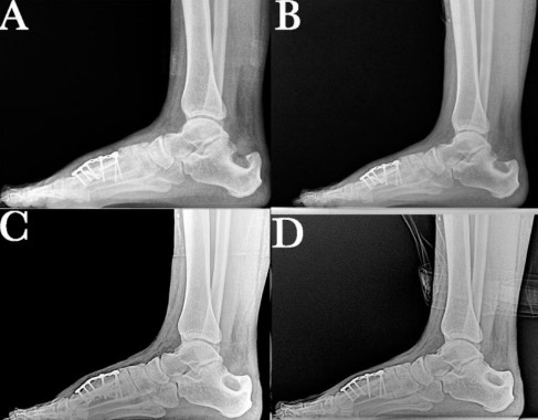Who Is Best Performs Calcaneus Osteotomy Surgery In Scottsdale