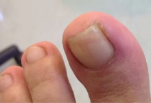 How to Get Rid of an Ingrown Fingernail