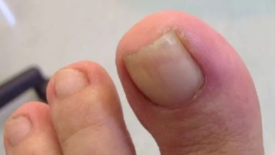 How to Get Rid of an Ingrown Fingernail