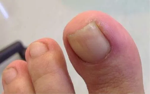 How to Get Rid of an Ingrown Fingernail