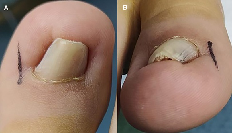 What Is the Recovery Time After a Matricectomy