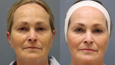 Laser Skin Tightening in New Jersey: Meet the Power of Erbium YAG Laser Treatments